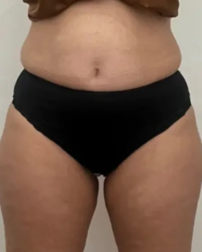 Abdomen y caderas de frente antes del tratamiento