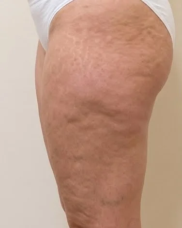 Muslo con celulitis y retención antes del tratamiento