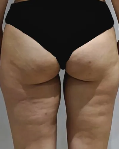 Glúteos y muslos con celulitis antes del tratamiento